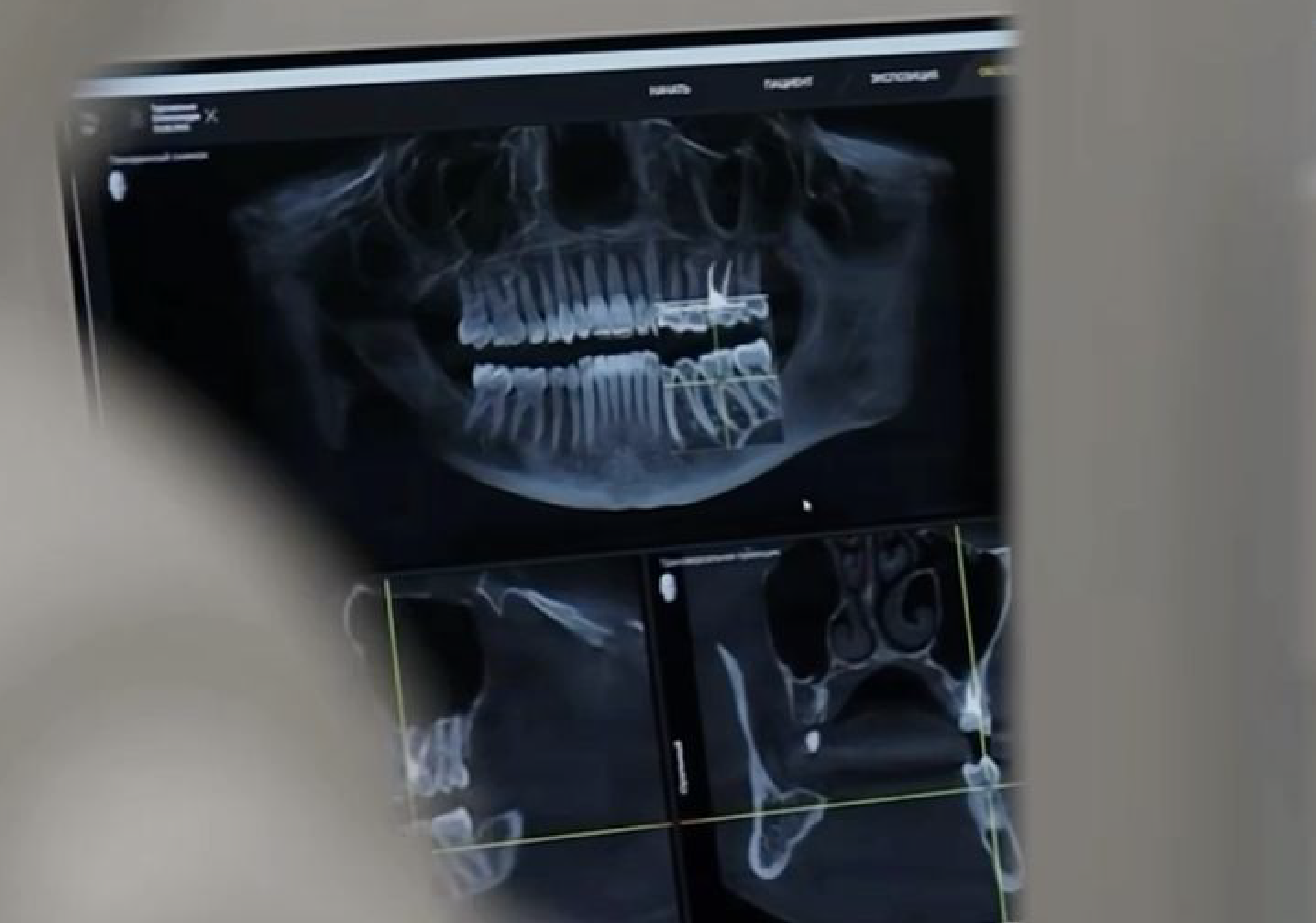 計畫評估，測顱 X 光照片照射 -2